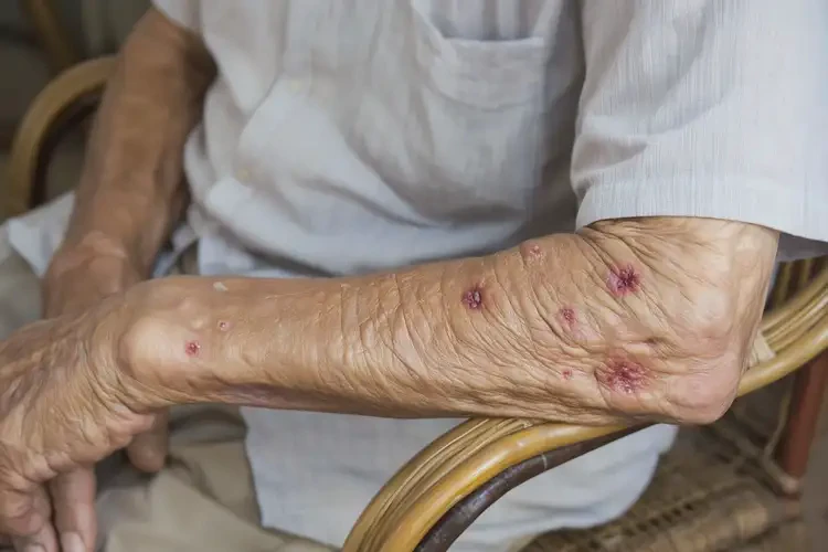 高齡老人四肢容易長濕疹不管它會(huì)自己自愈嗎(圖4)