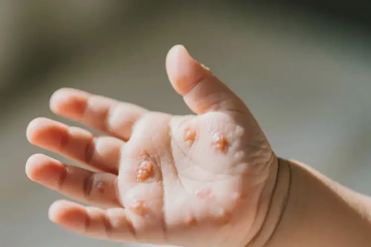 新生儿手上有湿疹不管它会自己好吗(图2)