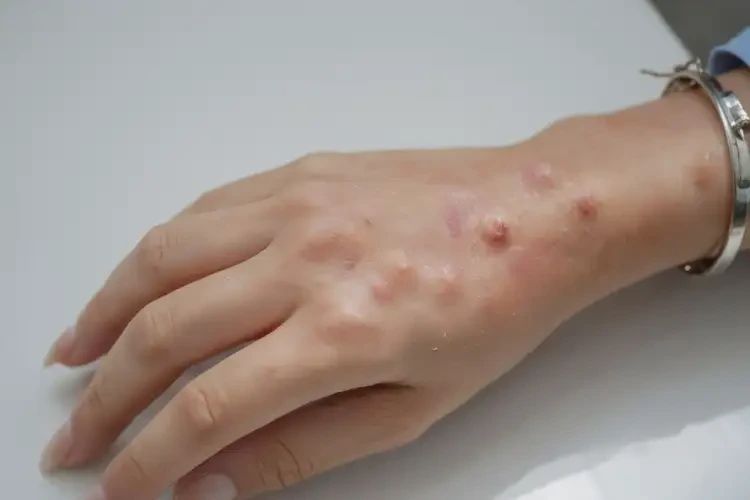 女人手上容易長(zhǎng)濕疹可以徹底自愈嗎(圖4)
