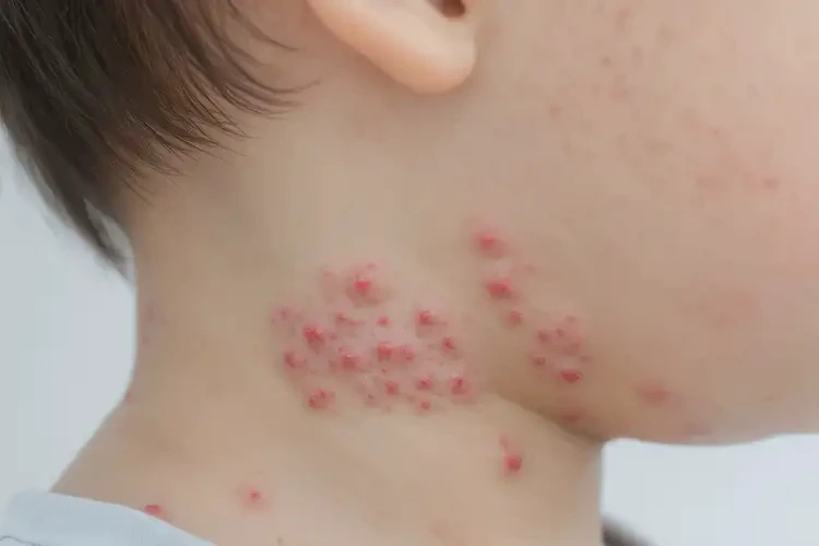 兒童脖子上出濕疹可以徹底自愈嗎(圖4)