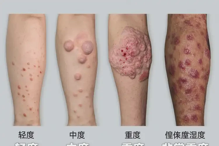 男生四肢出濕疹不管它會(huì)自己好嗎(圖1)