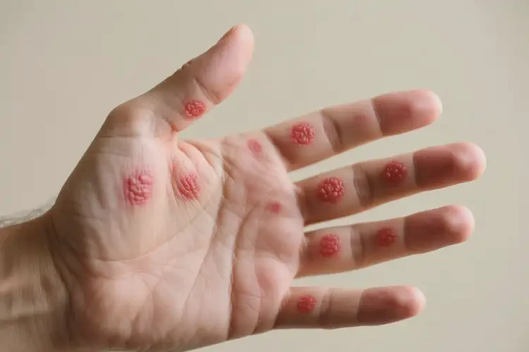 男人手上經(jīng)常長濕疹能不能徹底自愈(圖4)