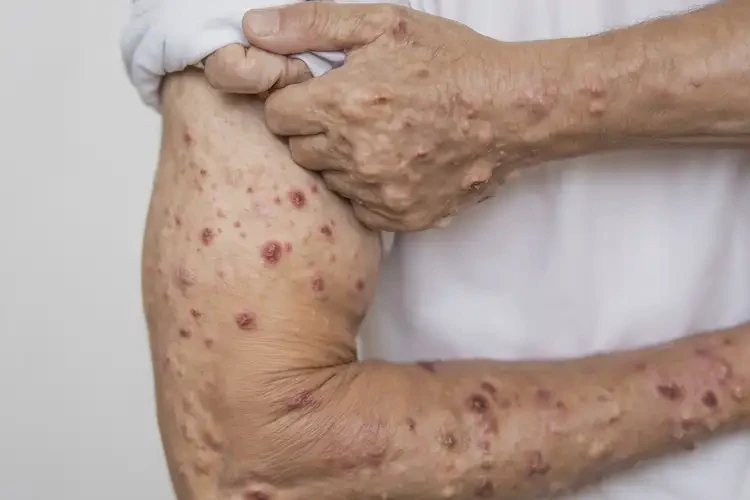 男生全身經(jīng)常起濕疹能徹底自愈嗎(圖4)