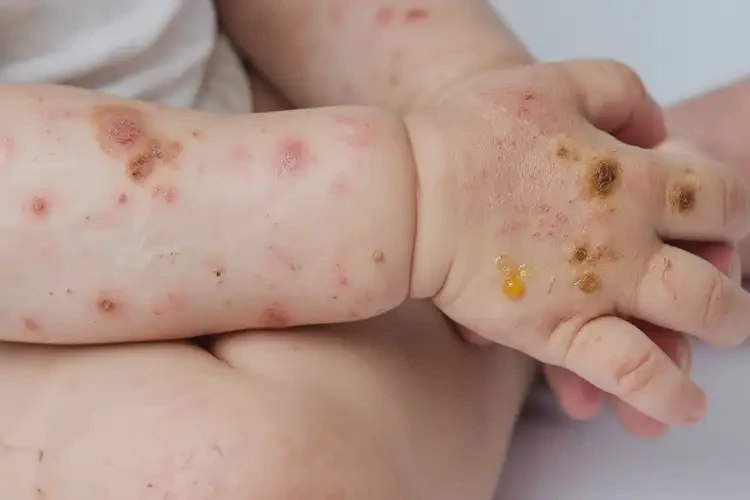 儿童四肢偶尔起湿疹不管它会自己好吗(图2)