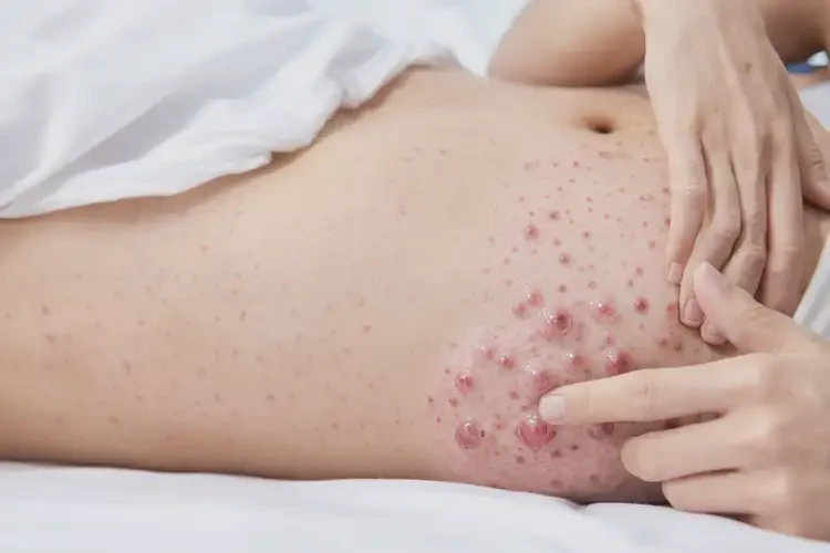 女性肚子長濕疹不管它會自己自愈嗎(圖4)