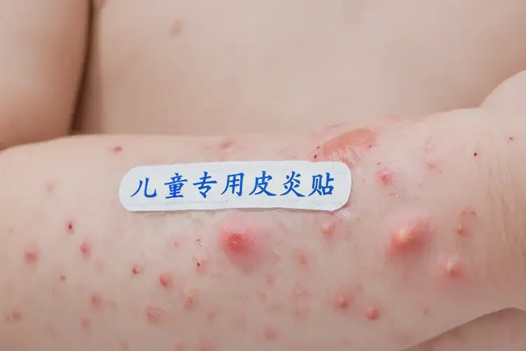 孩子全身經(jīng)常起濕疹能靠自己自愈嗎(圖4)