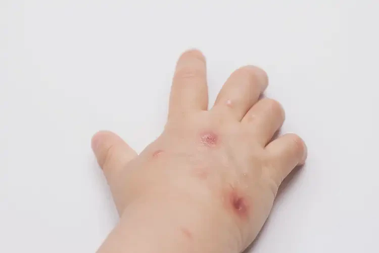 小兒手上起濕疹不管它會(huì)自己好嗎(圖3)