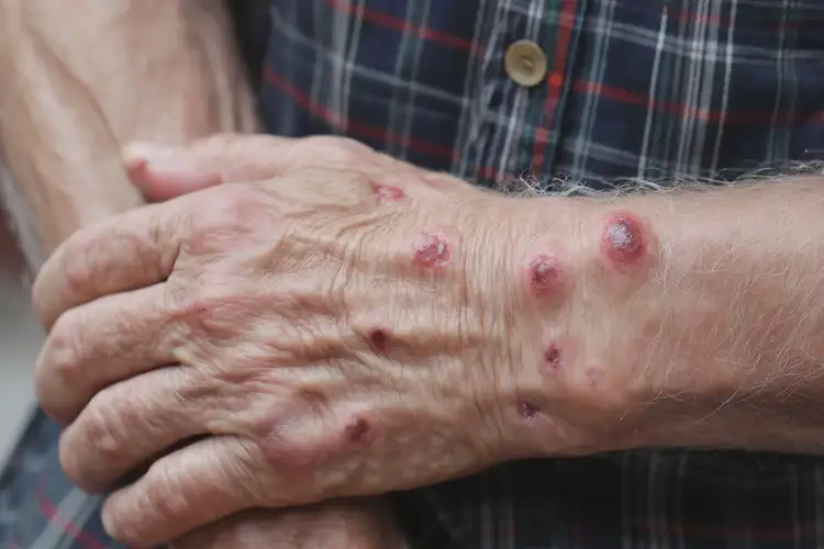 高齡老人手臂上容易起濕疹不管它會自己自愈嗎(圖4)
