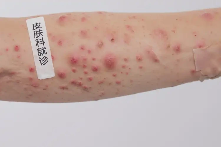 產(chǎn)婦手臂上出現(xiàn)濕疹不管它會(huì)自己自愈嗎(圖4)