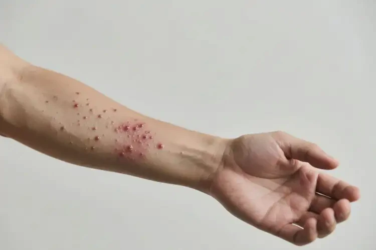 男性手臂長濕疹能靠自己自愈嗎(圖4)