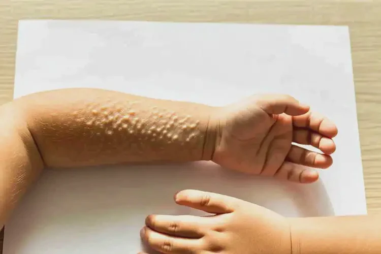 小兒手臂經(jīng)常長(zhǎng)濕疹不管它會(huì)自己好嗎(圖2)