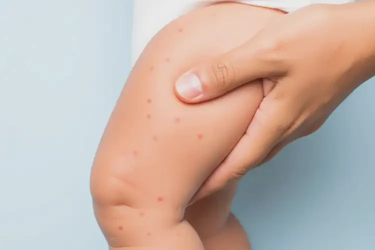 嬰兒大腿上經(jīng)常長濕疹不管它會自己好嗎(圖3)