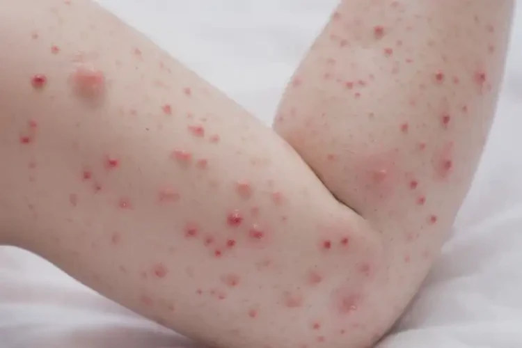 寶寶大腿上長濕疹能靠自己自愈嗎(圖2)