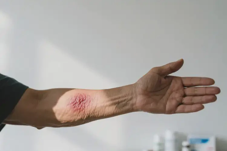 老人手臂上有濕疹不管它會自己痊愈嗎(圖2)