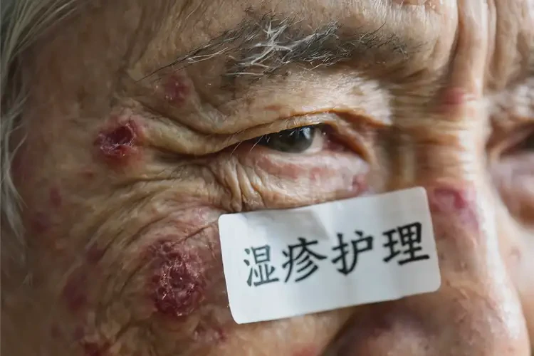 老人面部容易起湿疹能彻底自愈吗(图4)