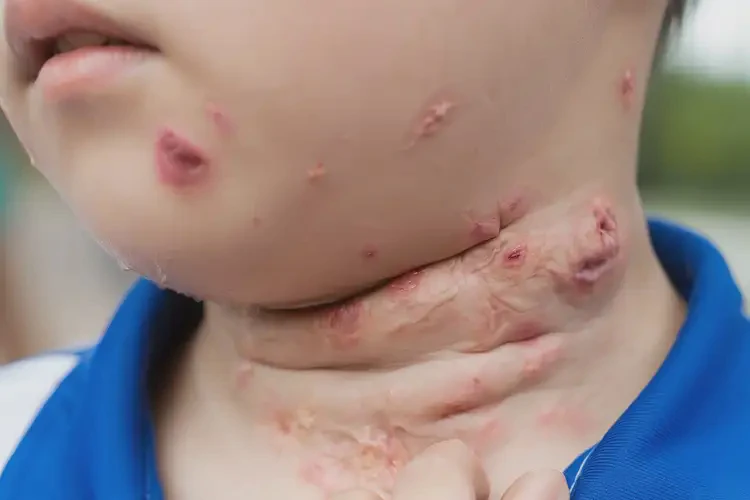 小學生脖子經常起濕疹能徹底自愈嗎(圖4)