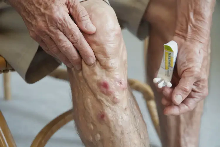 高齡老人小腿上出現(xiàn)濕疹不管它會(huì)自己自愈嗎(圖3)