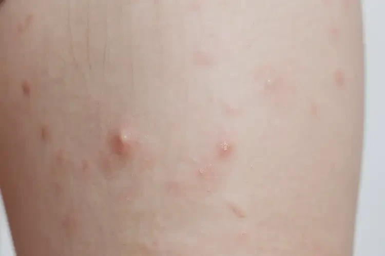 小孩大腿上偶爾長(zhǎng)濕疹不管它會(huì)自己痊愈嗎(圖4)