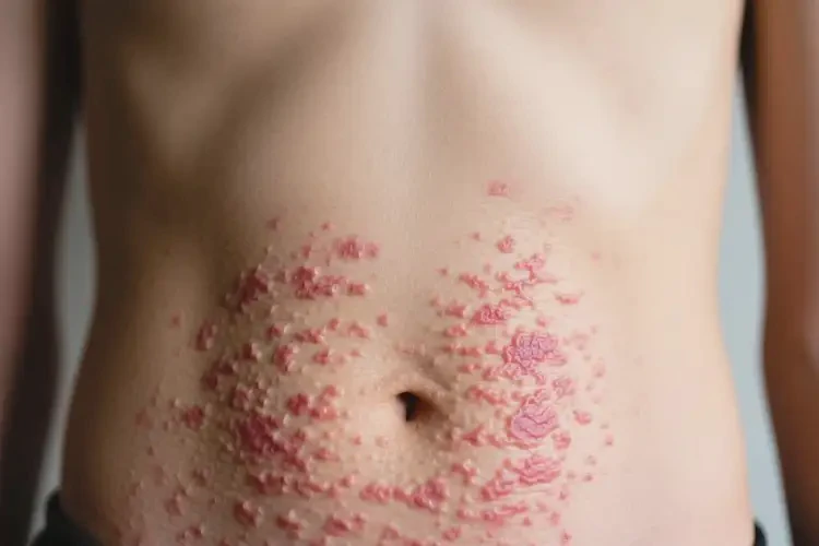 中學(xué)生肚子上出現(xiàn)濕疹能靠自己自愈嗎(圖2)