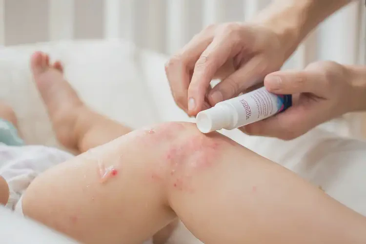 嬰幼兒大腿上有濕疹不管它會(huì)自己自愈嗎(圖3)