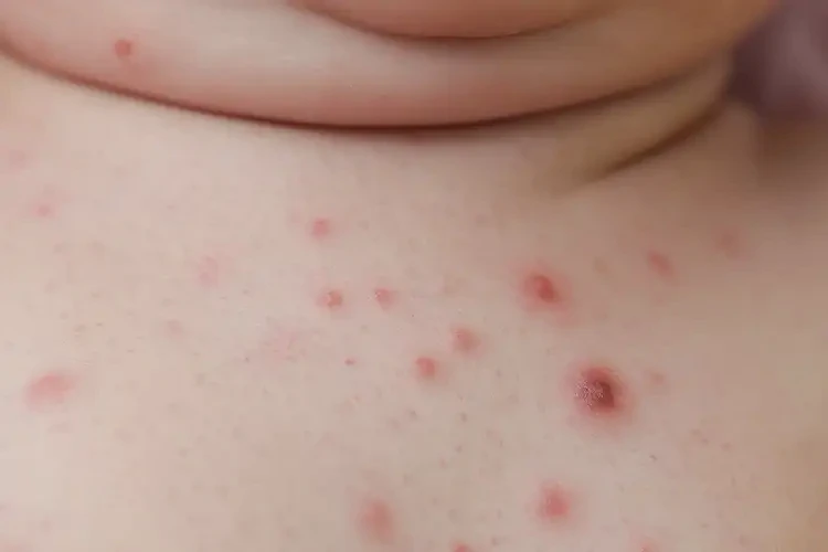 新生儿脖子经常起湿疹能彻底自愈吗(图4)