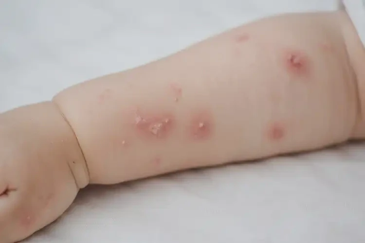 幼兒手臂上偶爾起濕疹能不能徹底自愈(圖4)