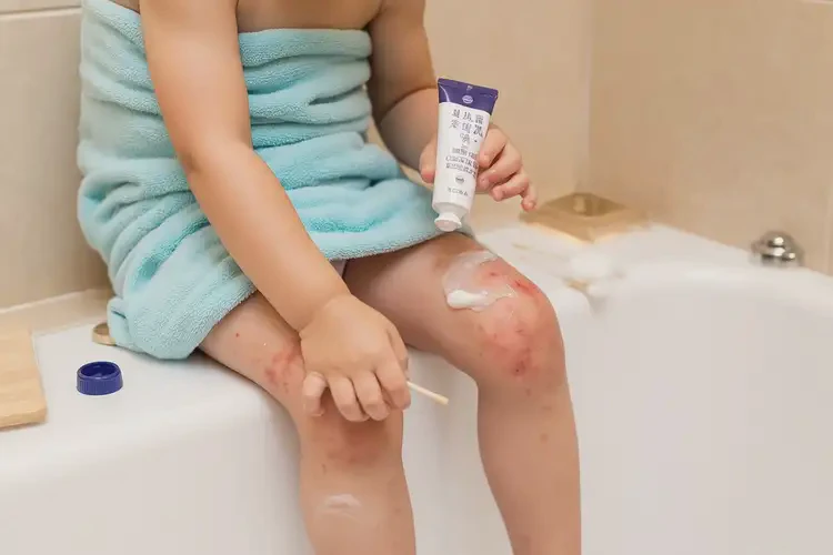 孩子全身起湿疹能彻底自愈吗(图2)