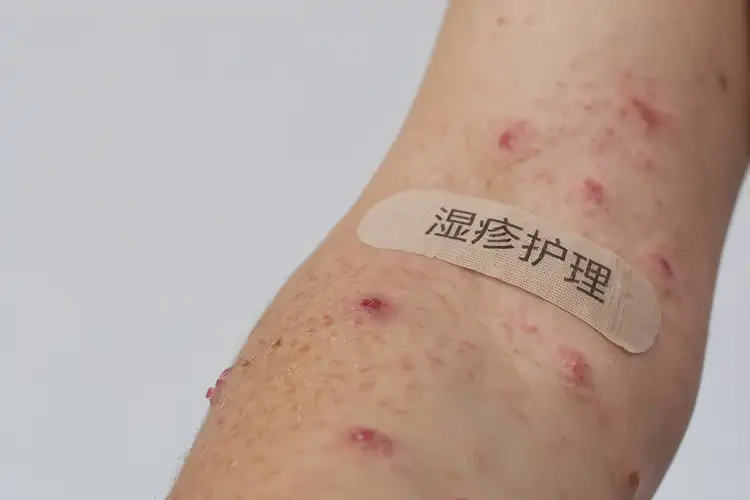 青少年手臂上容易起濕疹能靠自己自愈嗎(圖4)