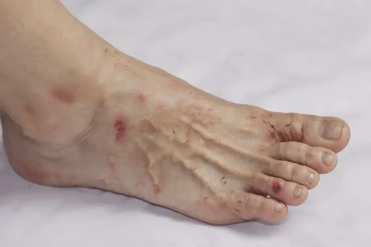 女性腳上出現(xiàn)濕疹能靠自己自愈嗎(圖3)