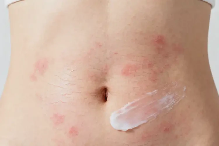 女性肚子长湿疹可不可以彻底自愈(图2)