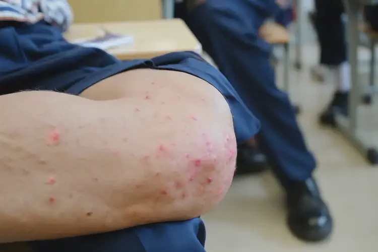 中学生屁股容易起湿疹能够彻底治愈吗(图4)