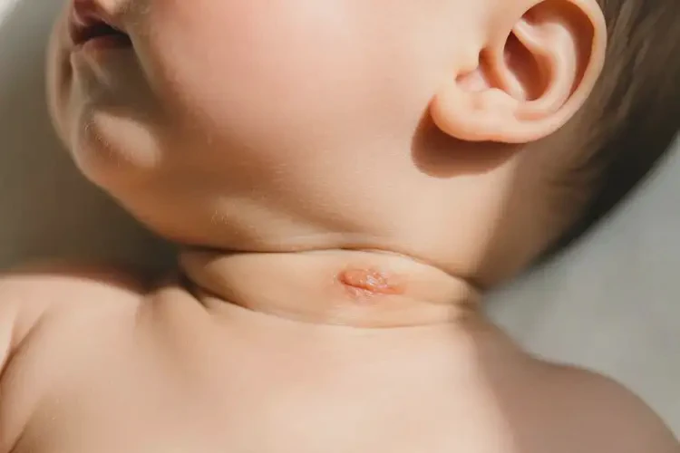 嬰幼兒脖子上偶爾長濕疹能靠自己自愈嗎(圖2)