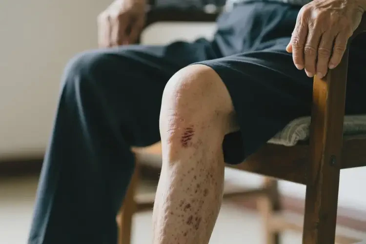 老人大腿上偶尔长湿疹可不可以彻底自愈(图2)