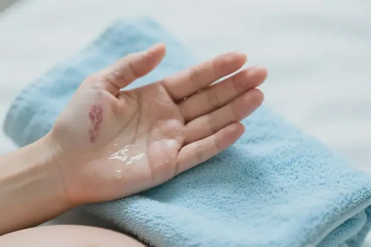 孕婦手上出濕疹可以徹底自愈嗎(圖2)