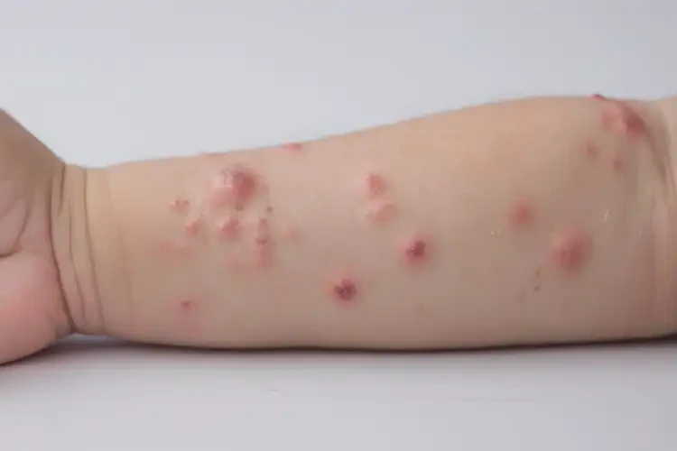 小兒手臂上偶爾起濕疹能夠徹底治愈嗎(圖4)