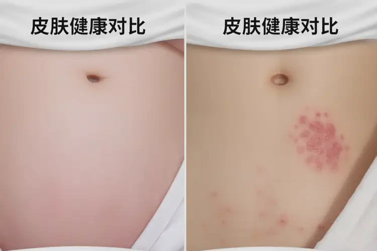 新生兒肚子上起濕疹可以徹底自愈嗎(圖2)