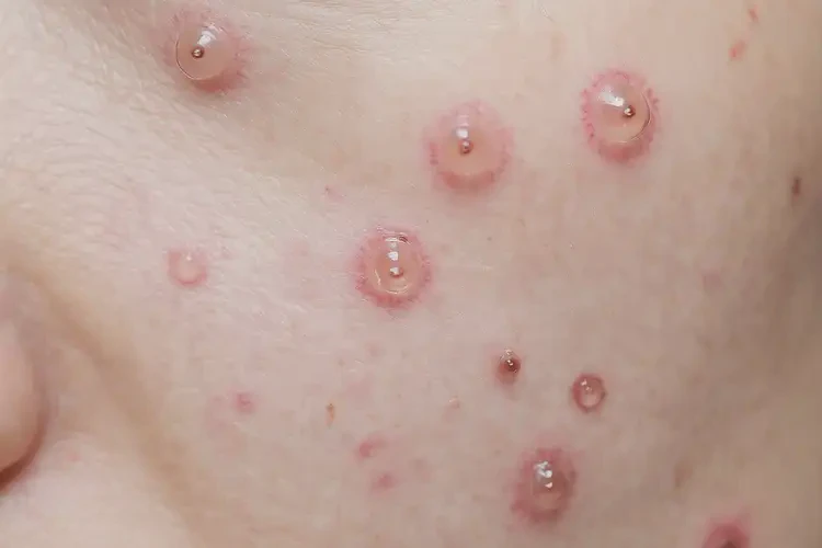 男性肛周偶爾長(zhǎng)濕疹不管它會(huì)自己自愈嗎(圖4)