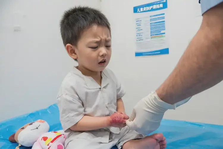 兒童肛周出濕疹能靠自己自愈嗎(圖4)