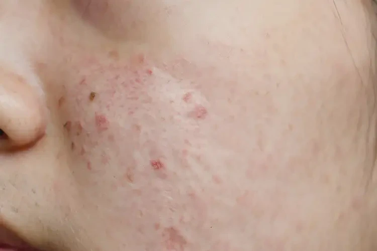 大学生脸上偶尔起湿疹不管它会自己自愈吗(图4)