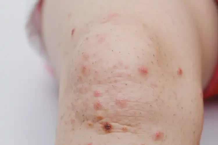 孩子小腿出现湿疹不管它会自己自愈吗(图4)