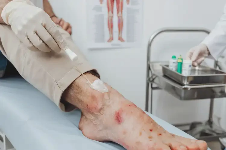 男人腳上有濕疹能不能徹底自愈(圖3)