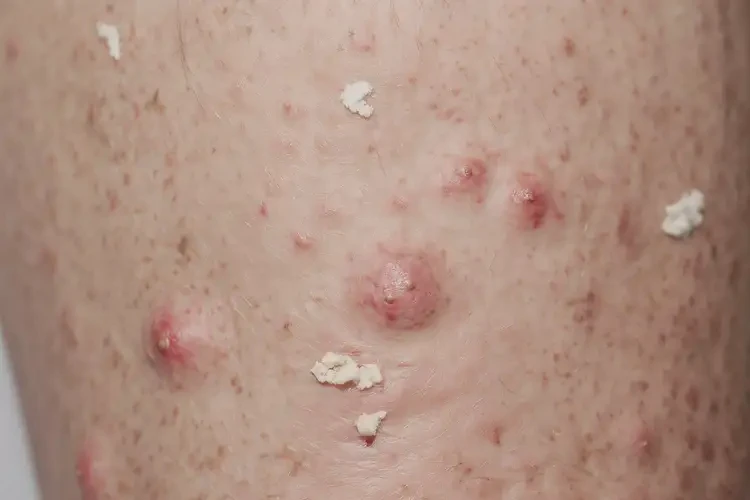 老年人大腿容易起濕疹不管它會自己自愈嗎(圖4)