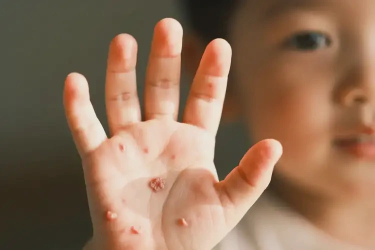 小孩手上有濕疹能徹底自愈嗎(圖4)