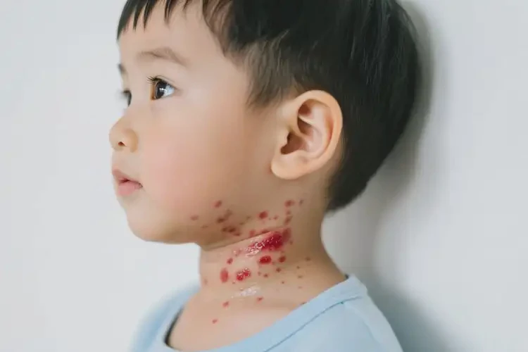 小孩脖子長濕疹不管它會自己好嗎(圖1)