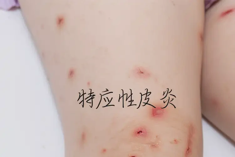 兒童大腿上起濕疹不管它會(huì)自己好嗎(圖4)