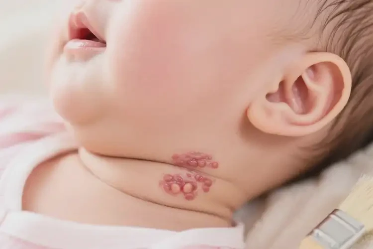 嬰兒脖子出現(xiàn)濕疹不管它會自己痊愈嗎(圖1)