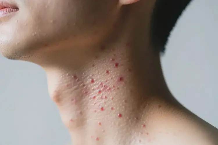 男性脖子上長濕疹不管它會自己好嗎(圖4)