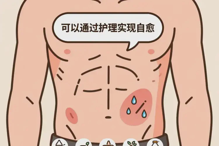 男性肚子出現濕疹可不可以徹底自愈(圖1)