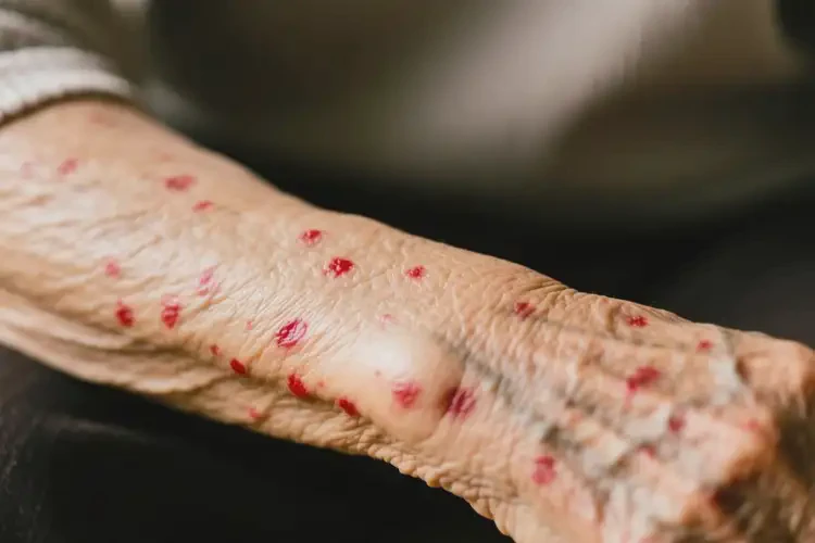 老年人手臂上出現(xiàn)濕疹能不能徹底自愈(圖3)