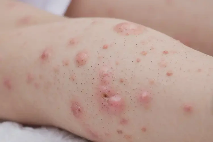 儿童四肢偶尔起湿疹不管它会自己好吗(图3)